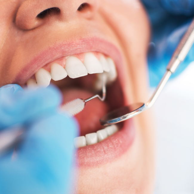 Up to 20% discount on dental fillings, treatment and calculus removal service