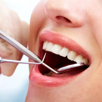 20% discount on teeth filling with white composite and removal of calculus
